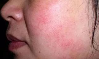 有红血丝怎么办 有红血丝怎么办