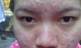 脸上长痘痘该怎么办 脸上长痘痘该怎么办