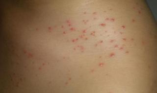 紫癫性皮炎 紫癫性皮炎